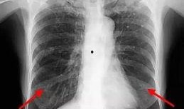 胸片爆料2023年最新版大揭秘,揭秘影像诊断新趋势